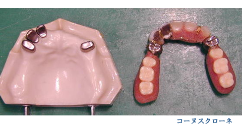 コーヌスクローネ