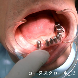 コーヌスクローネ02