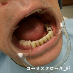 コーヌスクローネ03