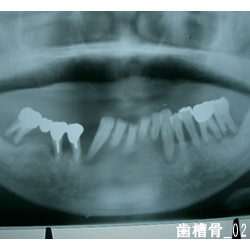 歯槽骨02