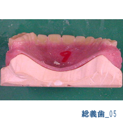 総義歯05