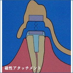 磁性アタッチメント01