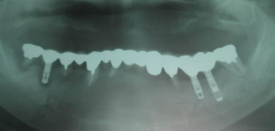 �C���v�����g�̃����g�Q���B�e�摜